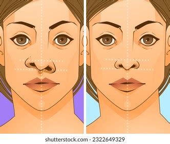 rhinoplasty tip   royalty  images stock