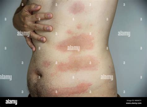 Man Getting Red Skin Rash At His Body Part People With Skin Allergy Problem Concept Stock