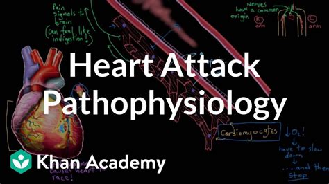 Heart Attack Myocardial Infarction Pathophysiology Nclex Rn Khan