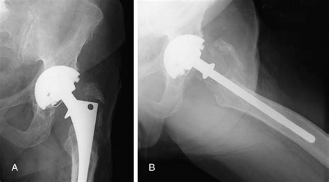 Treatment Of Symptomatic Greater Trochanteric Fracture After Total Hip