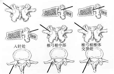 椎体成形术：pvp 和 Pkp 怎么选？ 德医学院 助力医学教育发展！