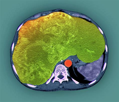 Liver Cancer Photograph By Zephyr Science Photo Library