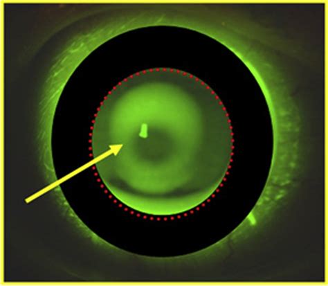 Visual Quality With Corneo Scleral Contact Lenses For Keratoconus