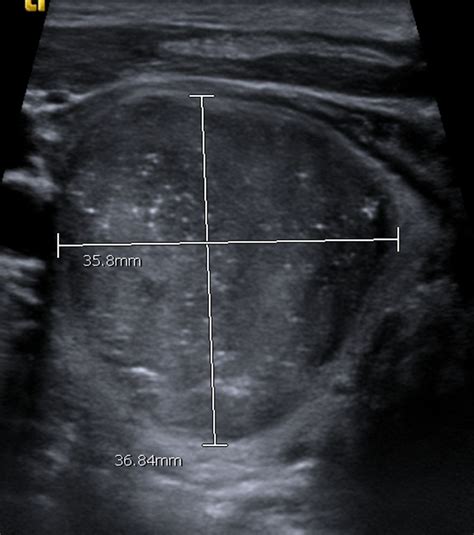 Medullary Carcinoma Thyroid Ultrasound