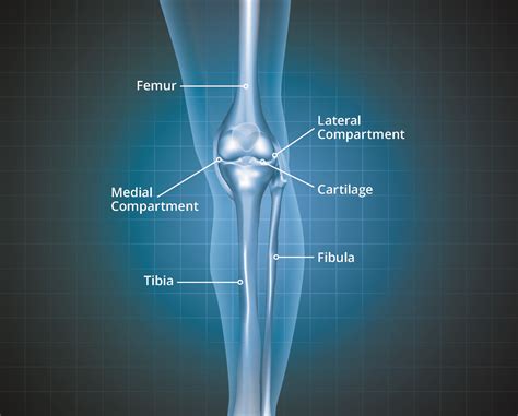 Knee Osteoarthritis Thuasne