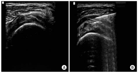 Figure Shows Ultrasound Guided Subacromial Subdeltoid Bursa Injection