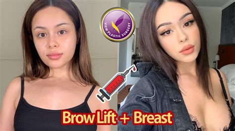 View Plastic Surgery Endotine Brow Lift Motiva Breast Implant YouTube