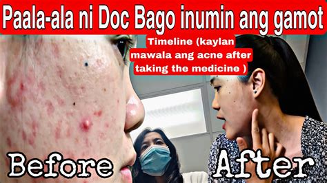 Paala Ala Pag Uminom Ng Gamot Na Resita Ng Doctor Para Mawala Ang