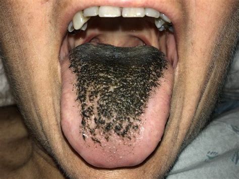 Black Hairy Tongue Medizzy