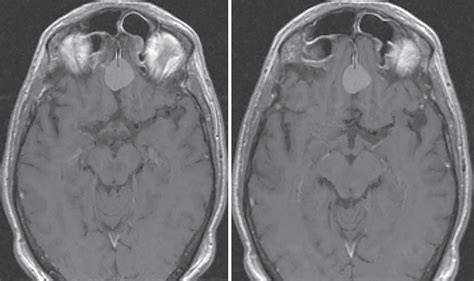 Olfactory Groove Meningioma Upfront Radiosurgery Radiology Key