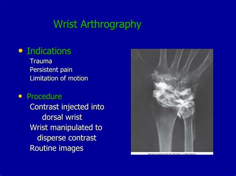 Ppt What Is Contrast Arthrography Powerpoint Presentation Free