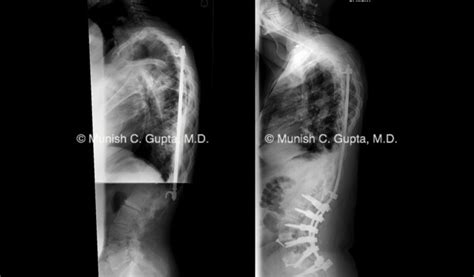 Adult Idiopathic Scoliosis Fusion Munish C Gupta Md