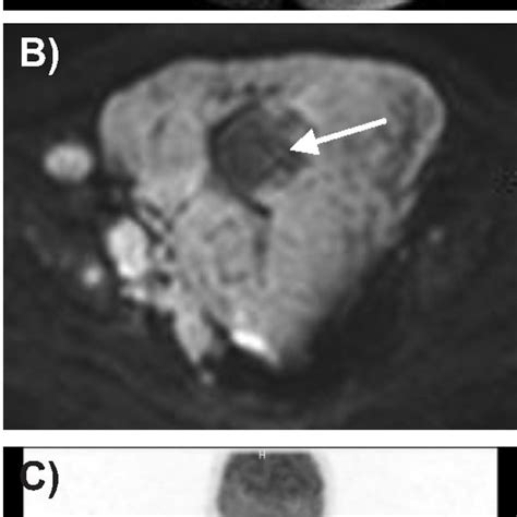 A T2 Weighted Magnetic Resonance Image Shows The Mass Hyperintense