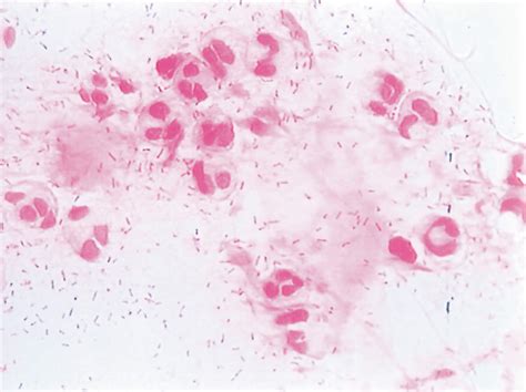 Community Eye Health Journal Conjunctivitis Diagnosis And Management