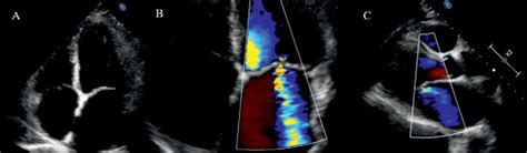 Transthoracic Echocardiography A Four Chamber Apical View Complete