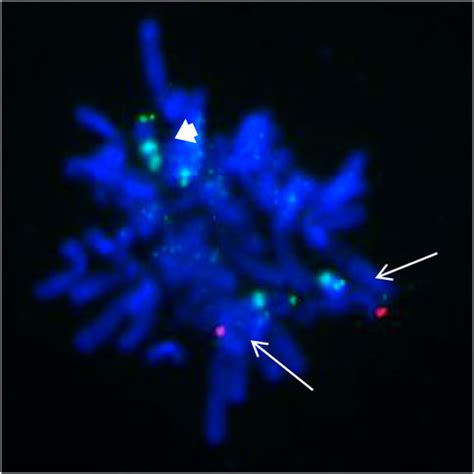 Frontiers Case Report Prenatal Diagnosis Of Fetal Tetrasomy P