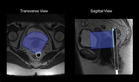 Transrectal Ultrasound For Image Guided Adaptive Brachytherapy In Cervix Cancer An Alternative