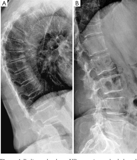 Osteoporotic Vertebral Fracture