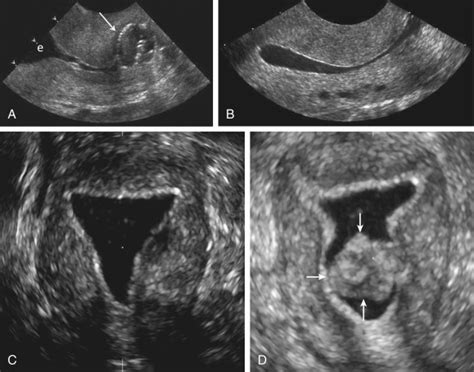 Abnormal Transvaginal Ultrasound