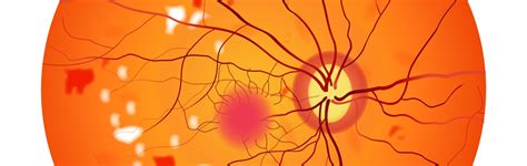 Diabetic Retinopathy-Mild Disease - Dr Rehman Siddiqui