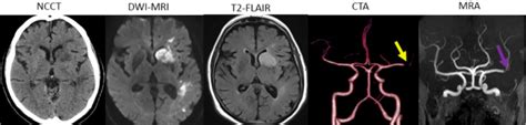 Imagenología De La Cabeza Y El Cerebro Concise Medical Knowledge