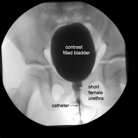 Voiding Cystourethrogram