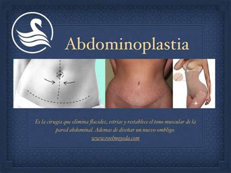 Abdominoplastia En Monterrey Lipectom A Dr Roel Moyeda