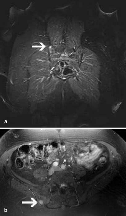 A B A 66 Year Old Patient With Thyroid Cancer A While Skeletal