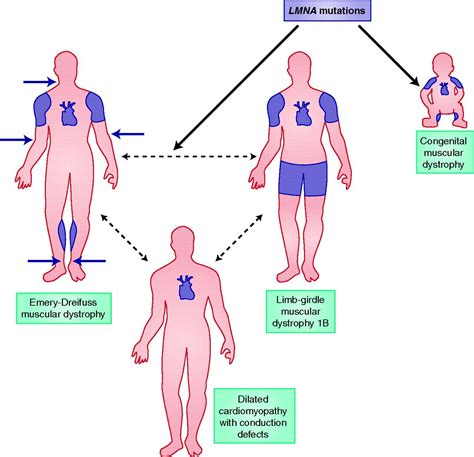 muscular dystrophy - Yahoo Image Search Results Muscular Dystrophies ...