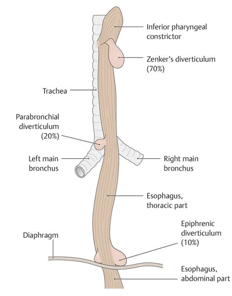 Types Of Esophageal Diverticulum