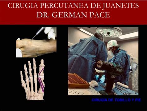 Cirugía percutánea del pie Pagina de Noticias Dr German Pace