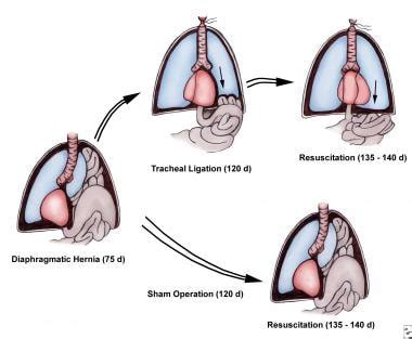 Diaphragmatic Hernias Treatment Management Approach Considerations