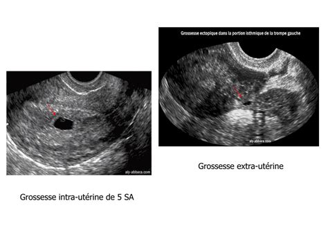 PPT ECHOGRAPHIE EN OBSTETRIQUE IRM FOETALE PowerPoint Presentation