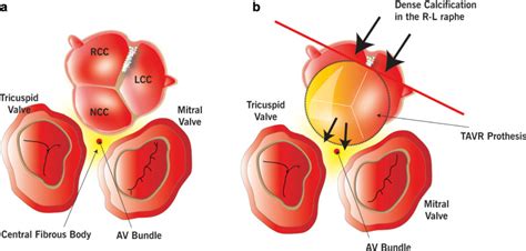 Bicuspid Aortic Valve Disease Classifications Treatments And