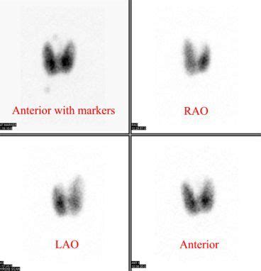 A I 123 Thyroid Uptake Scan Nuclear Medicine Pet Ct Nuc Med