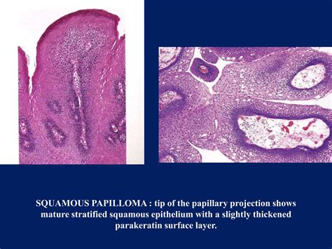 Benign Tumors Of Epithelial Origin Of Oral Cavity PPT