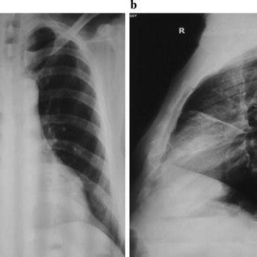 Chest X Ray A Postero Anterior And B Right Lateral View Showing