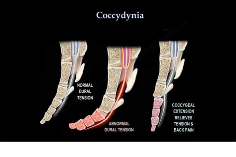 Coccydynia Orthopaedicprinciples