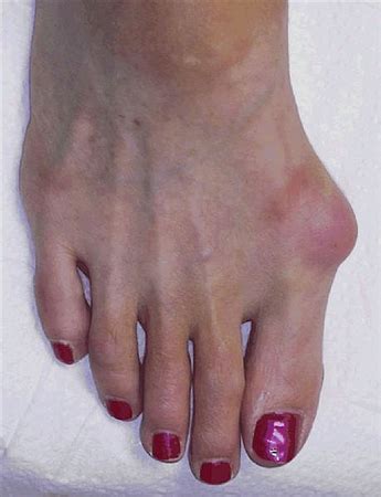 Hallux Valgus Foot Ankle Orthobullets