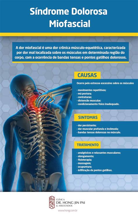 Síndrome Dolorosa Miofascial Causas Sintomas Tratamentos Clínica