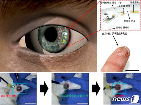 Unst 연구진 콘택트렌즈로 당뇨병 진단 기술 개발 네이트 뉴스