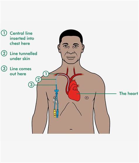 Hickman line, PICC line insertion for Bone – Dr. Kushan Nanavati ...