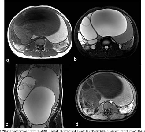 Mri Appearances Of Mucinous Borderline Ovarian Tumors Pathological