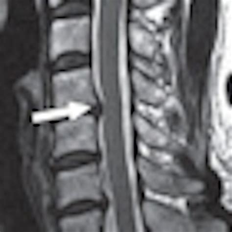 Mri Grading System Shows Promise For Cervical Canal Stenosis Auntminnie