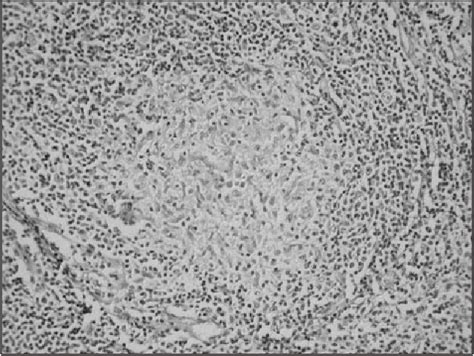 Figure 2 From Cervical Lymph Node Metastasis Of Extramedullary