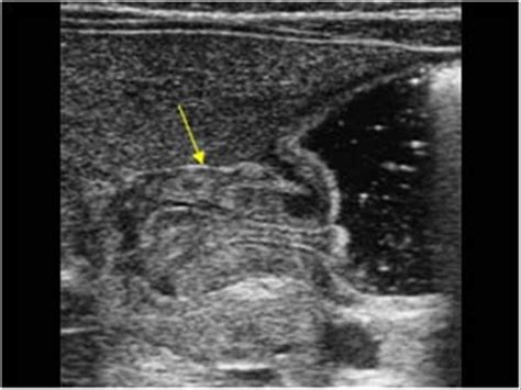 Pediatrics | 9.1 Pediatric abdomen and retroperitoneum : Case 9.1.1 ...