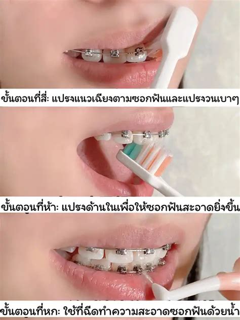 จัดฟันลาดกระบัง การค้นหาใน Lemon8