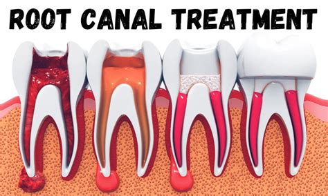 Exploring The Depths Essentials Of Root Canal Treatment Richardson