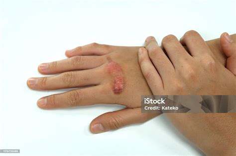 Scalded Hand Of Woman With Injury By Boiling Water Burn Stock Photo