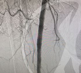 Angioplastia Dos Membros Inferiores Folino Gama